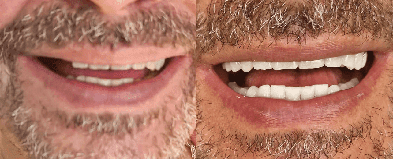 Rezultat Estetică Dentară Premium - CMI Dr. Meda Munteanu